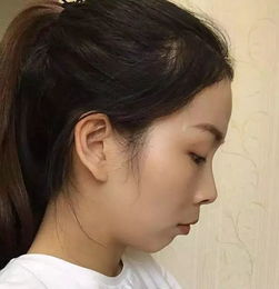 在郑州,矫正牙齿最低多少钱