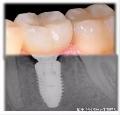 郑州种植牙选瑞士ITI种植牙好吗?副主任医师或主任医师种植牙是不是更有保障?