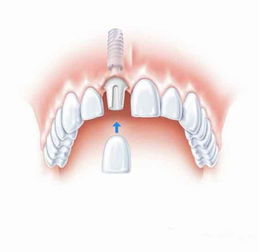 郑州市其他商务服务 种植牙原理技术