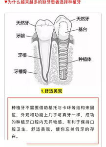 6月29日,来中原种植牙博览会,赢免费种植牙