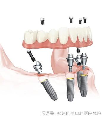 郑州种植牙|要稳固种植牙,这项操作很有必要!