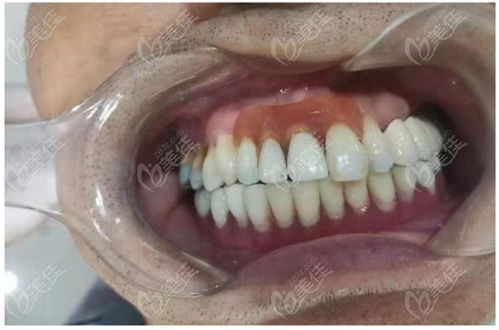 有人么 能给我说下现在在深圳龙岗做一颗韩国种植牙要多少钱吗