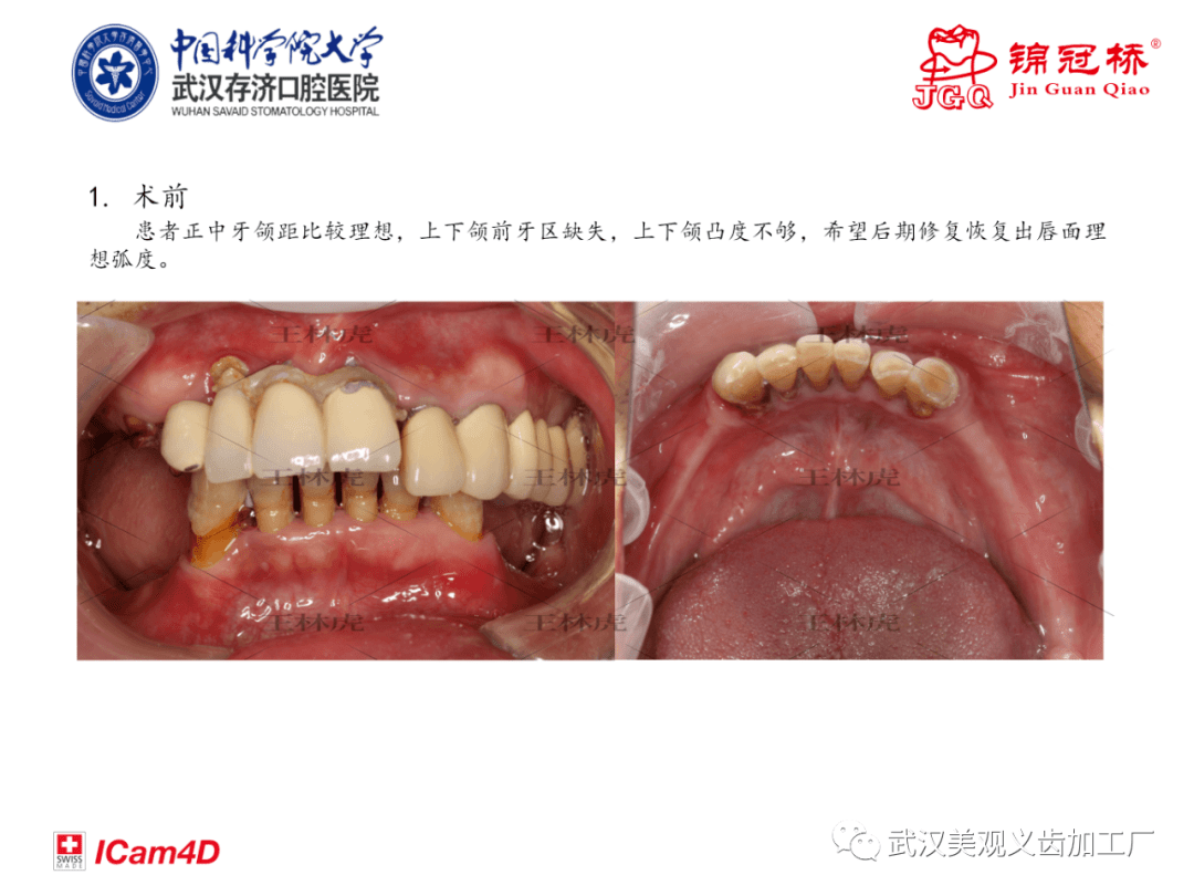 郑州瑞士iti种植牙:种植导板下无牙颌种植修复,恢复全口牙 - 