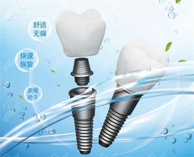 郑州德韩口腔种植牙费用多少?登腾种植牙3k+,奥齿泰种植牙5k+