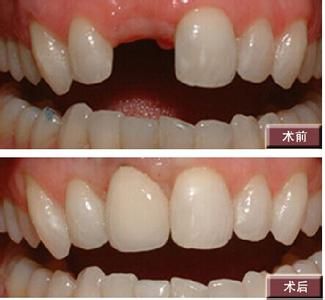 装一个烤瓷牙价格多少钱