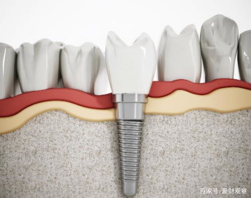 2022医疗迎来大变革,种植牙将被纳入医保集采,未来一颗牙多少钱