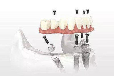 郑州种植牙技术特色解析 杭州西湖口腔医院的经验借鉴