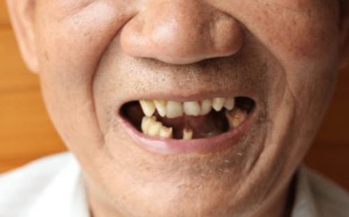 冲牙器的危害弊端与选购避坑点解析——郑州种植牙患者必读指南