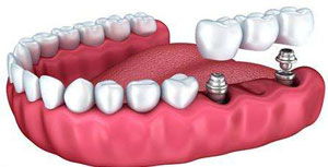 郑州种植牙费用解析 意外摔掉门牙后的完整指南