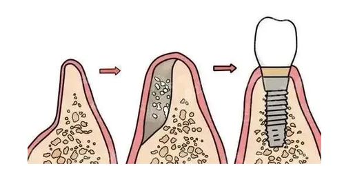 瑞士Bio-Oss骨粉产品介绍及其在郑州种植牙中的应用