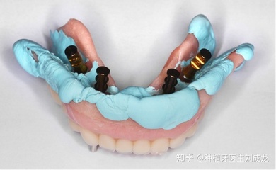 郑州瑞士ITI种植牙 导板技术引领无牙颌全口修复新高度