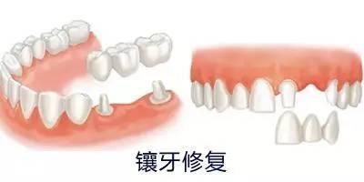 郑州种植牙与镶牙对比指南 如何根据自身情况做出明智选择