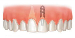 种植牙 缺牙修复的优选方案及其在郑州的选择指南