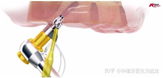 郑州全口/半口All-on-4种植牙 一场重塑生活品质的体验与医生选择指南