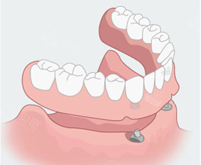 郑州半口种植牙费用全面解析 价格构成与选择指南